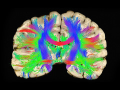 Why helmets don't prevent concussions — and what might
